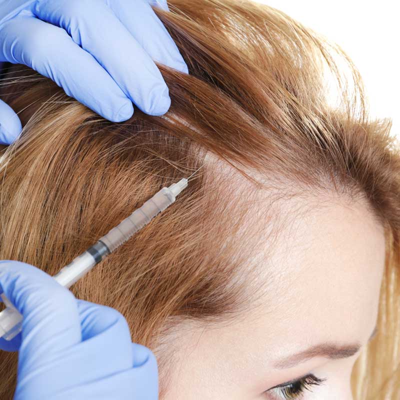 Alopecia Alopecia Dermatologic Disorders Merck Manuals Professional