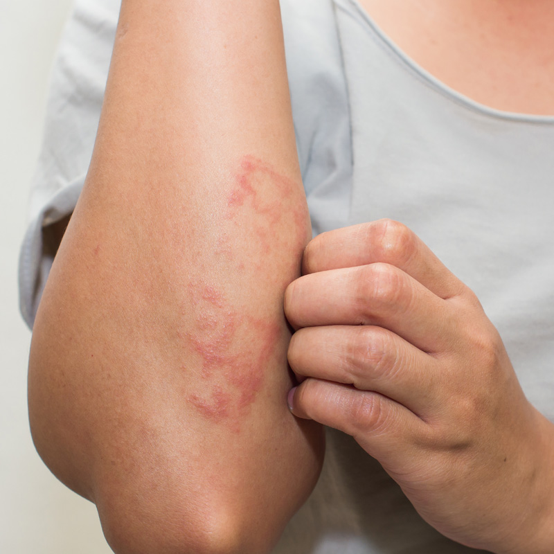 Red rash growing on the forearm of a woman that is a clear sign of Psoraisis