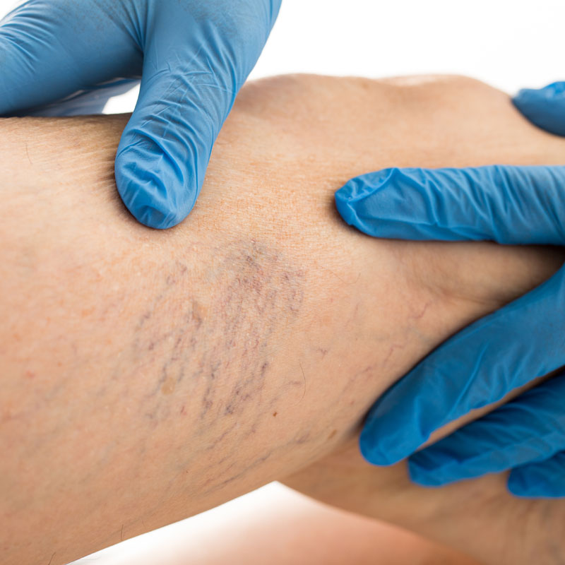 Varicose Veins Treatment: Is Treatment Permanent? - Worcester Dermatology  Associates - Chelmsford Dermatology Associates