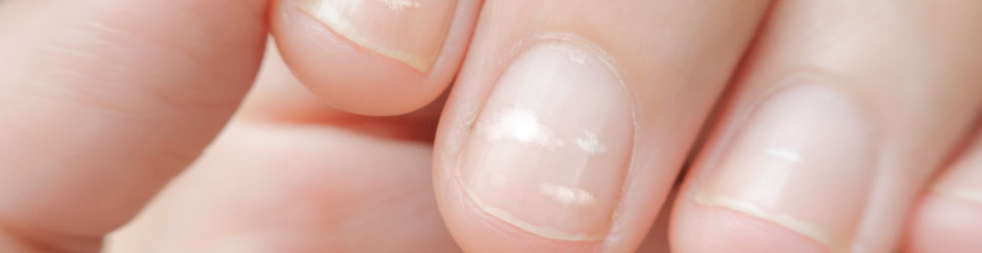 Nutrition and nail disease  ScienceDirect