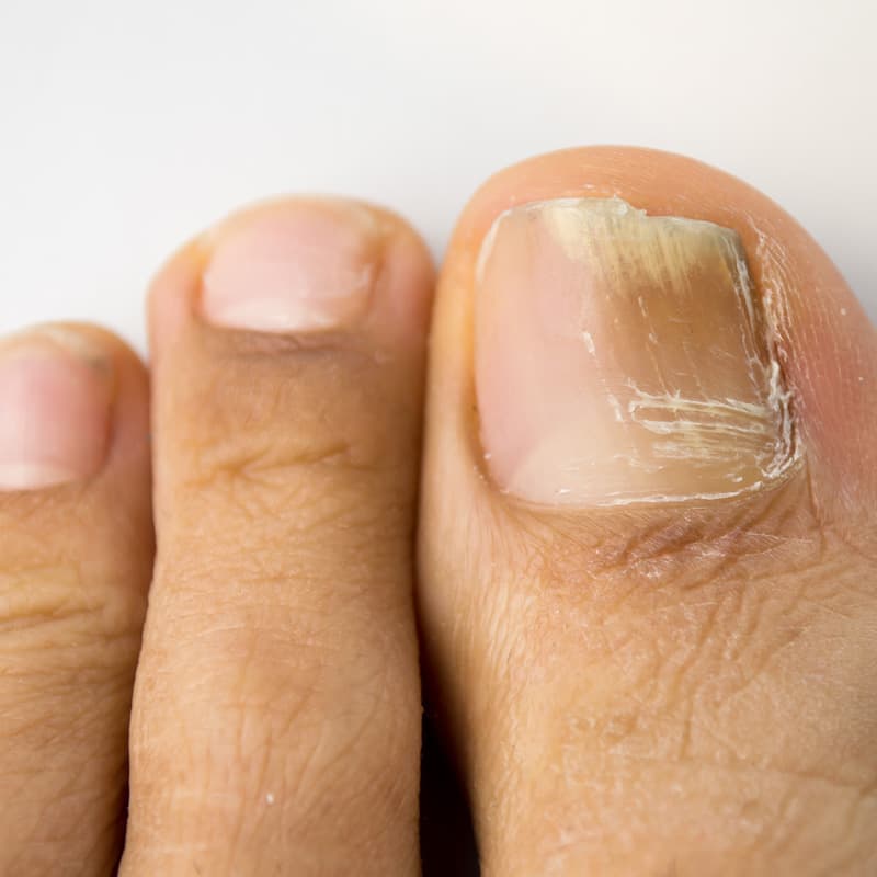 Nail fungal infection