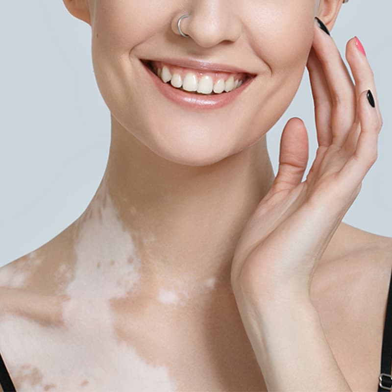 A woman smiling as the lower half of her neck has signs of discolor on her skin.