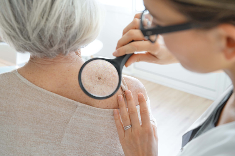 Dr examining a mole on an elderly woman