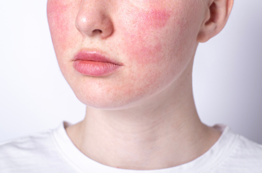 Omaha Rosacea Treatment: Symptoms & Flare-Ups