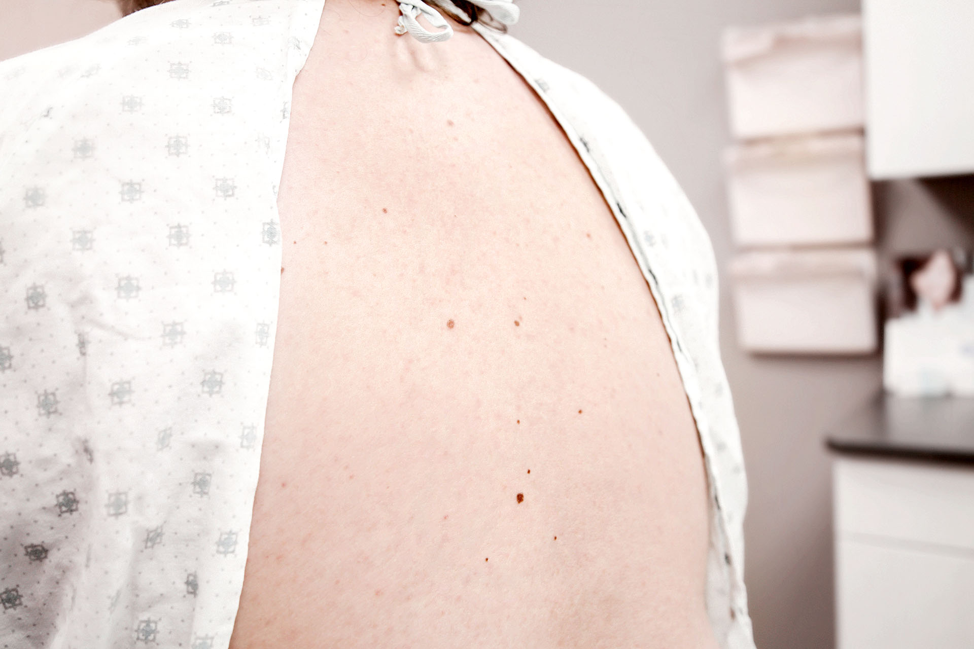 Skin Tag Removal West Omaha