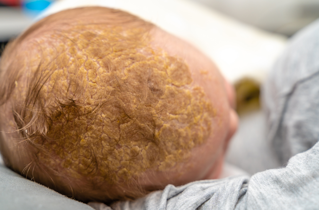 Cradle Cap on baby