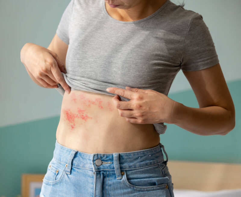 Shingles