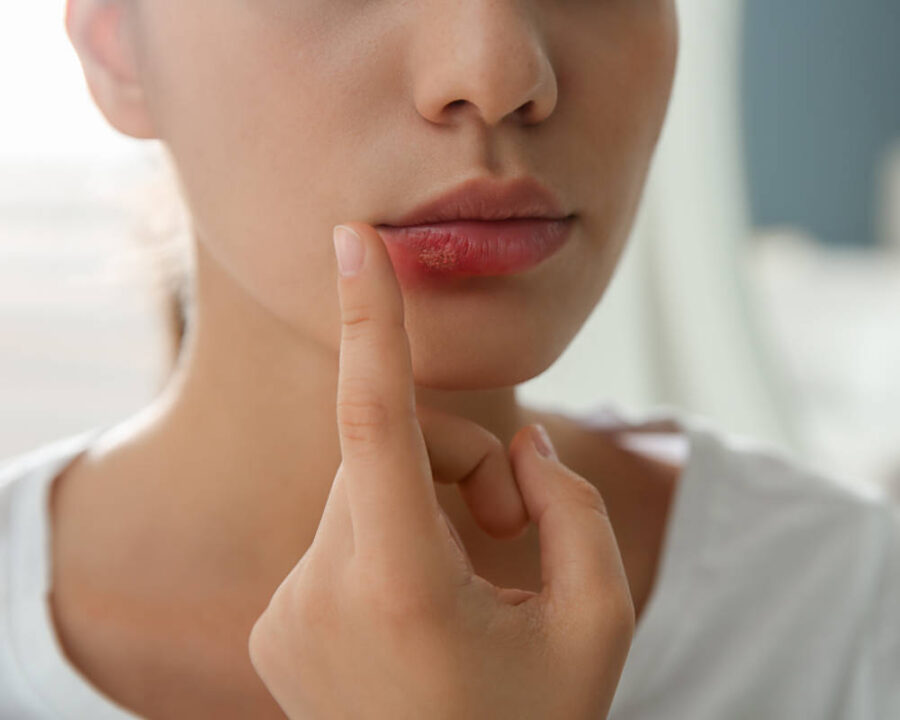 cold sore