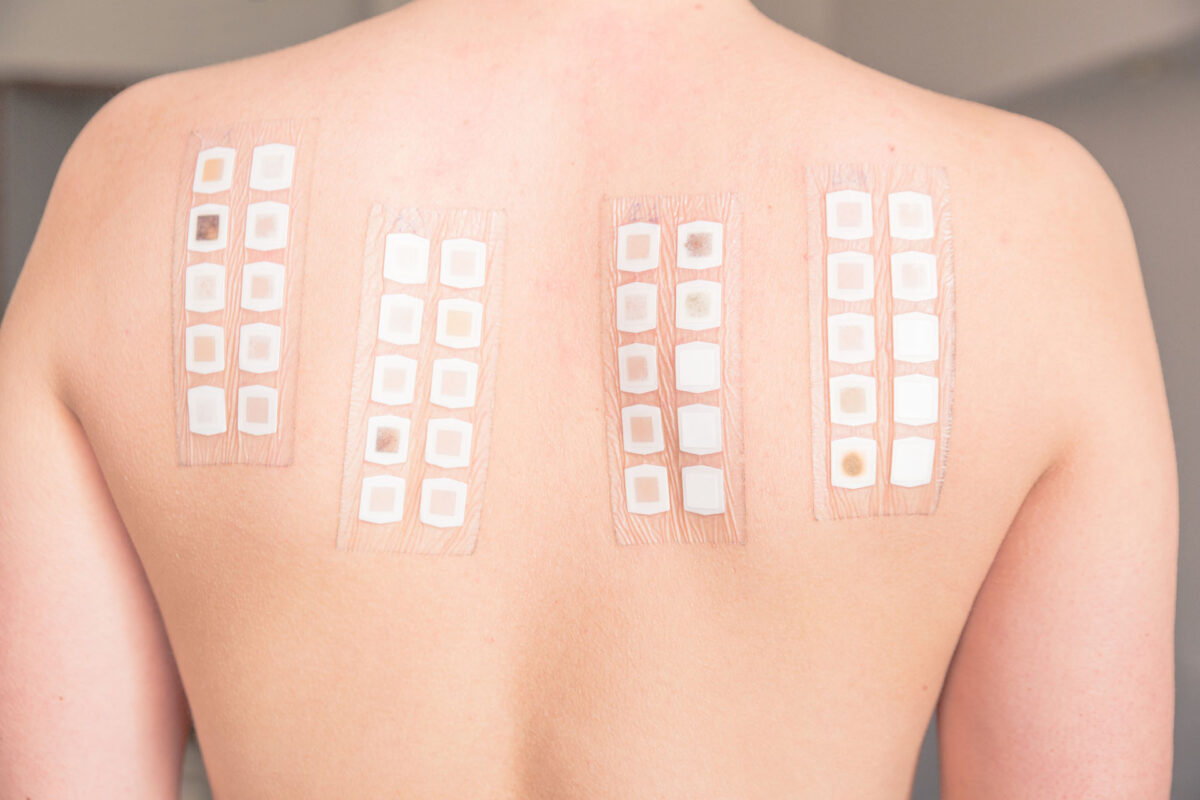 allergy testing