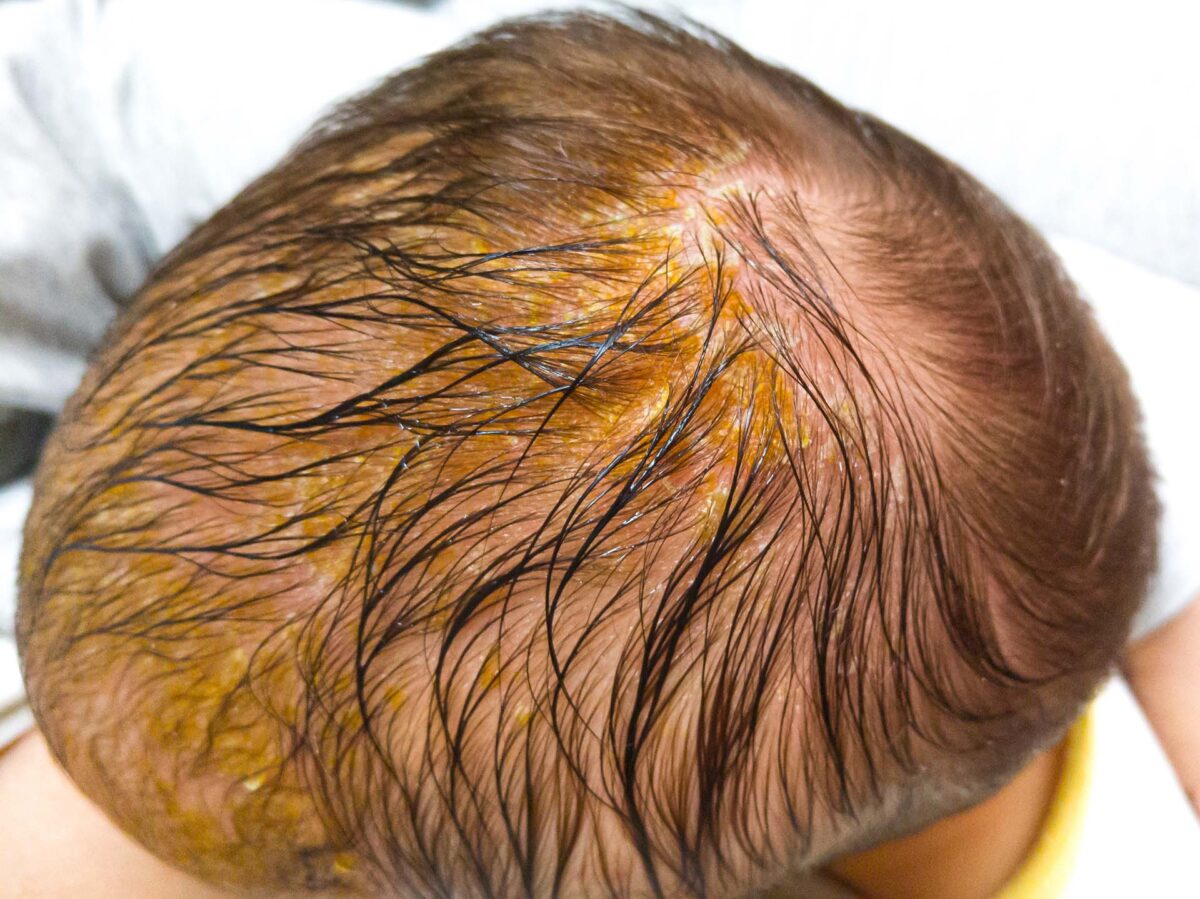 cradle cap