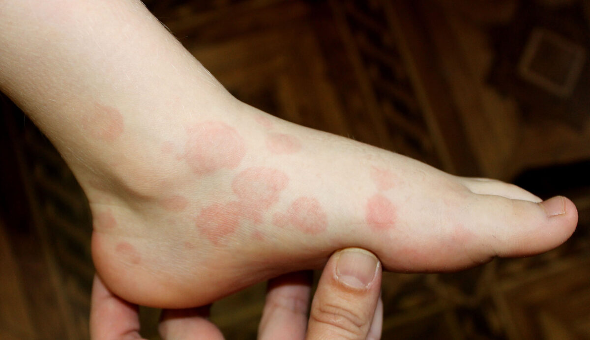 pediatric erythema