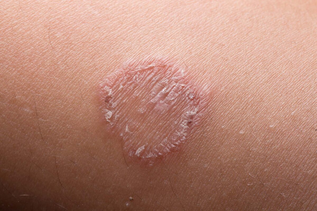 ring worm infection