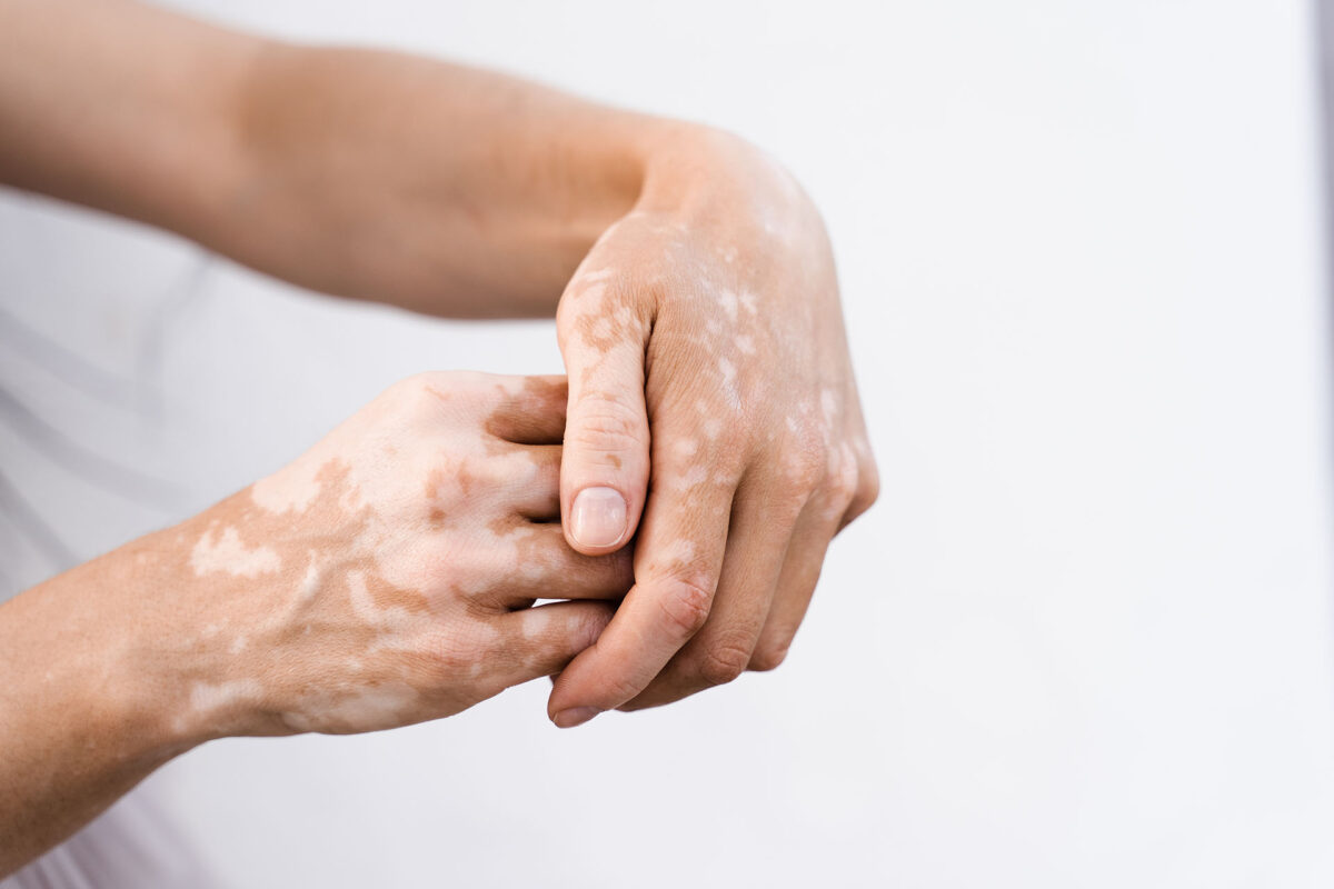 vitiligo skin disorder