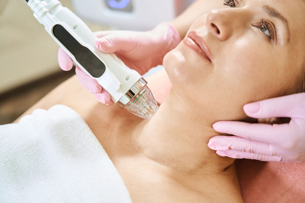 microneedling