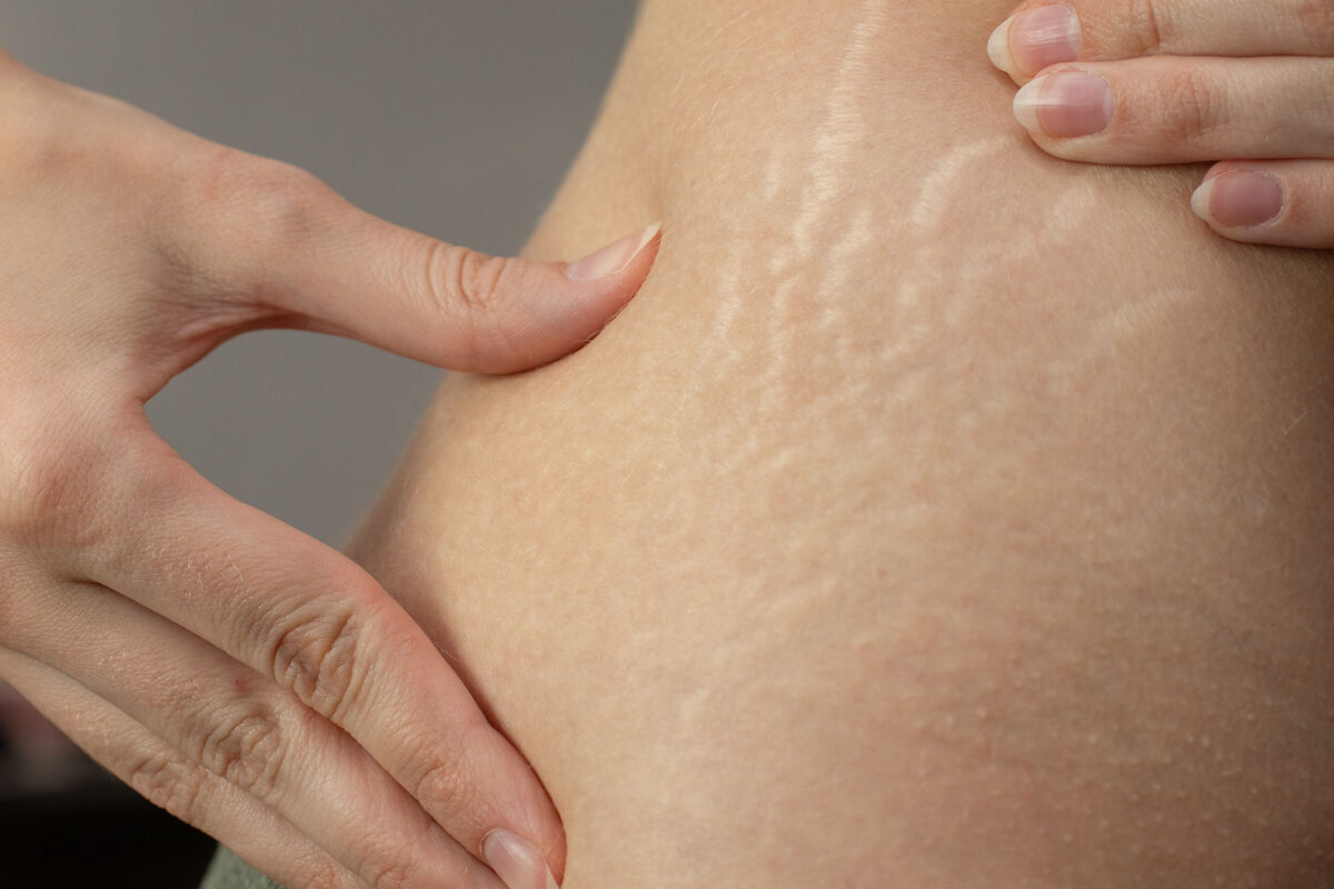 woman stretch marks